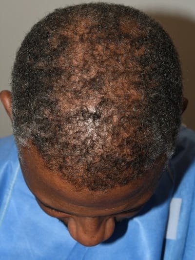 Hair Restoration for Men Before & After Gallery - Patient 297548 - Image 2