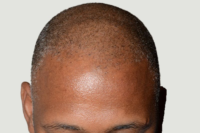 Hair Restoration for Men Before & After Gallery - Patient 790477 - Image 3