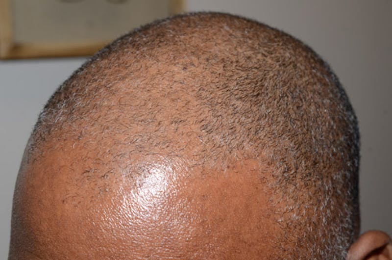 Hair Restoration for Men Before & After Gallery - Patient 790477 - Image 5
