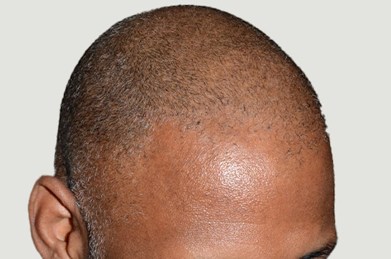 Hair Restoration for Men Before & After Gallery - Patient 790477 - Image 7