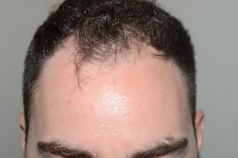 Hair Restoration for Men Before & After Gallery - Patient 373052 - Image 1