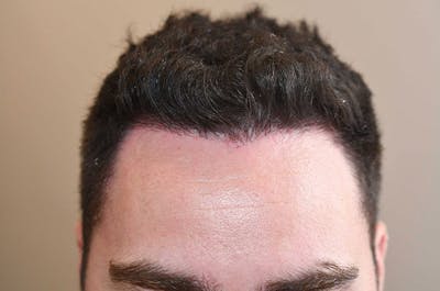 Hair Restoration for Men Before & After Gallery - Patient 244908 - Image 2