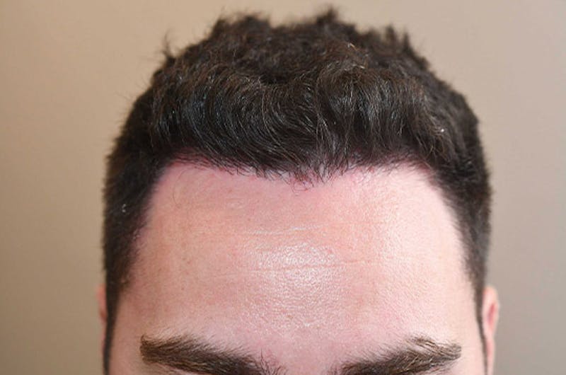 Hair Restoration for Men Before & After Gallery - Patient 373052 - Image 2