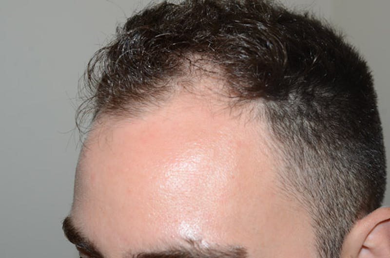Hair Restoration for Men Before & After Gallery - Patient 373052 - Image 3