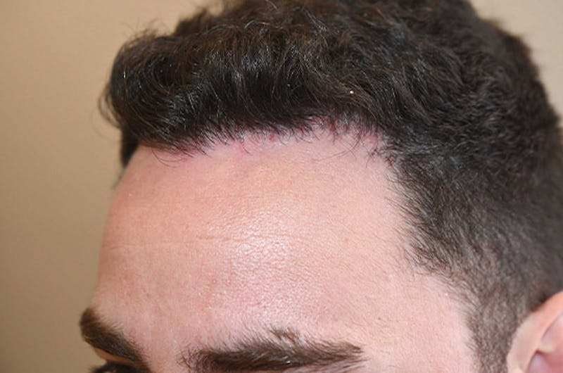 Hair Restoration for Men Before & After Gallery - Patient 373052 - Image 4
