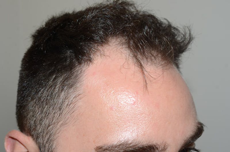 Hair Restoration for Men Before & After Gallery - Patient 373052 - Image 5