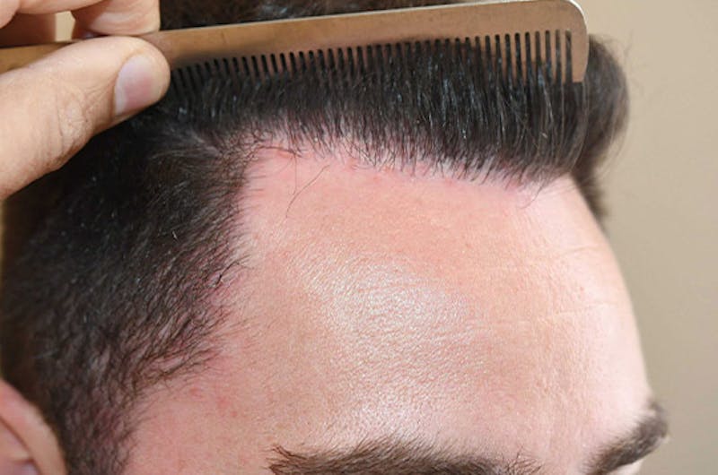 Hair Restoration for Men Before & After Gallery - Patient 373052 - Image 6