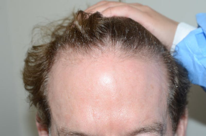 Hair Restoration for Men Before & After Gallery - Patient 346421 - Image 1