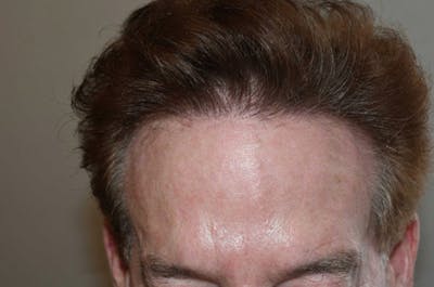 Hair Restoration for Men Before & After Gallery - Patient 148371 - Image 2