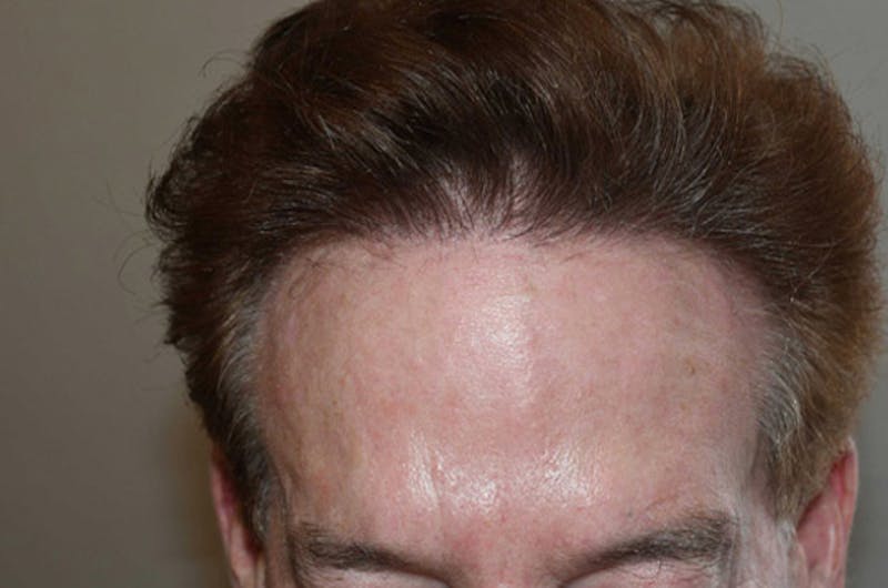 Hair Restoration for Men Before & After Gallery - Patient 346421 - Image 2