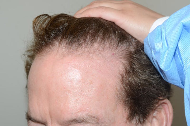 Hair Restoration for Men Before & After Gallery - Patient 346421 - Image 3