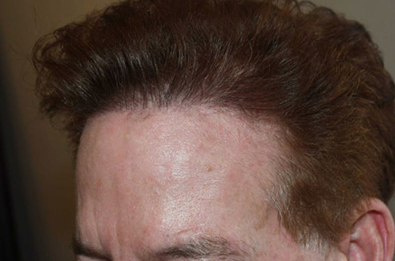 Hair Restoration for Men Before & After Gallery - Patient 346421 - Image 4