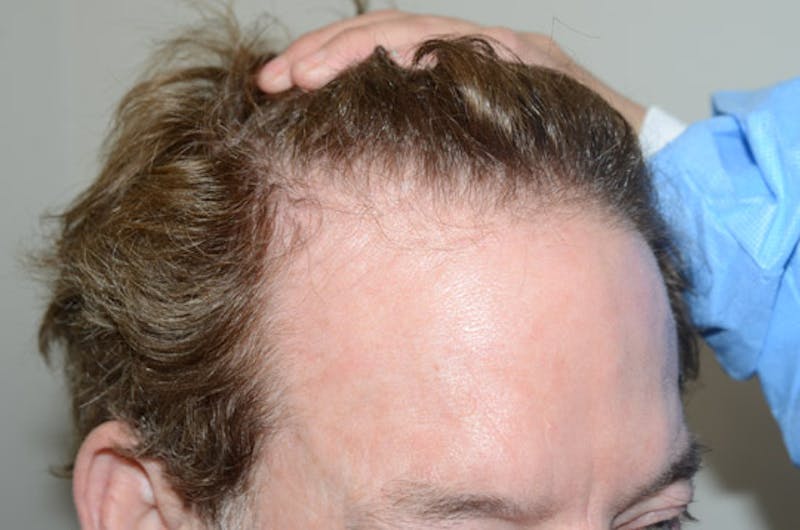 Hair Restoration for Men Before & After Gallery - Patient 346421 - Image 5