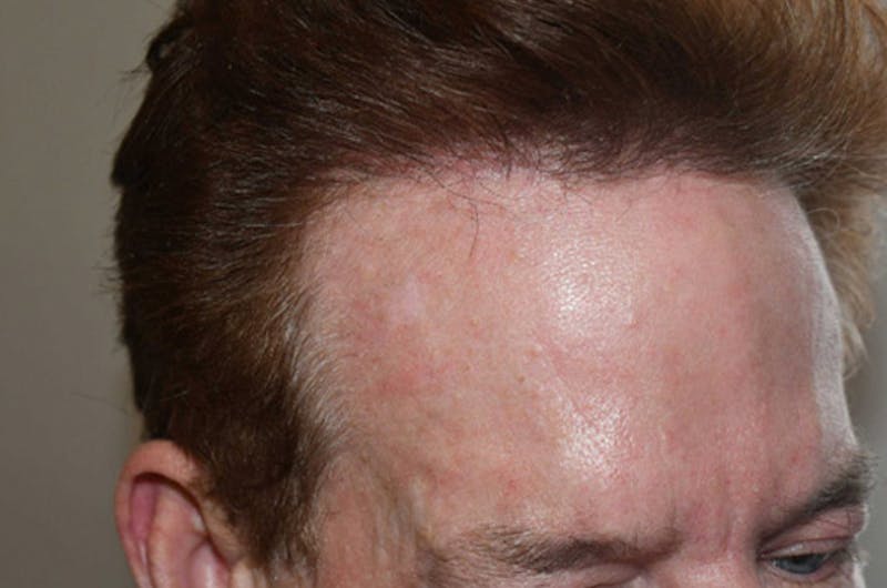 Hair Restoration for Men Before & After Gallery - Patient 346421 - Image 6