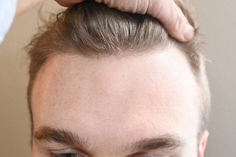 Hair Restoration for Men Before & After Gallery - Patient 982404 - Image 2
