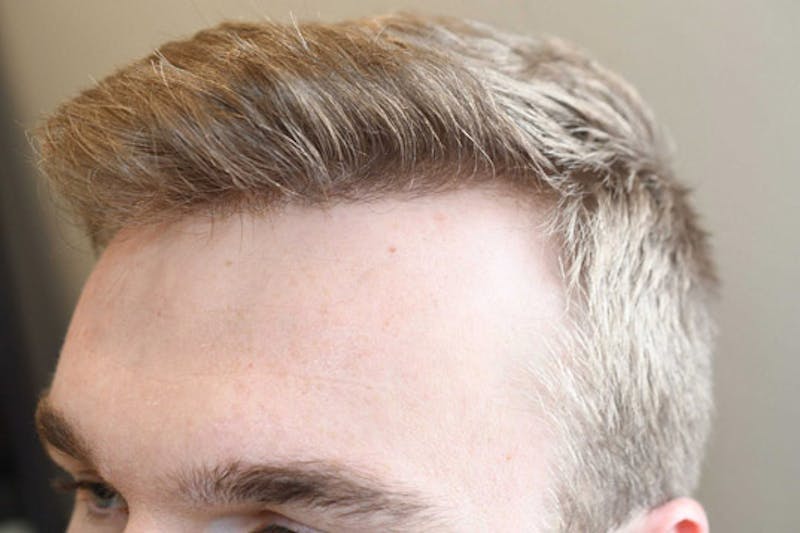 Hair Restoration for Men Before & After Gallery - Patient 982404 - Image 4