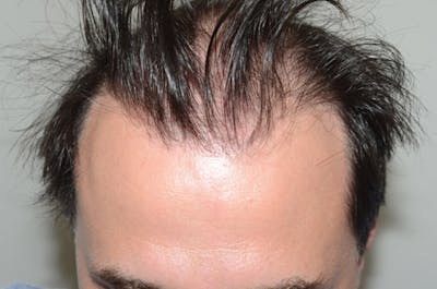 Hair Restoration for Men Before & After Gallery - Patient 130440 - Image 1