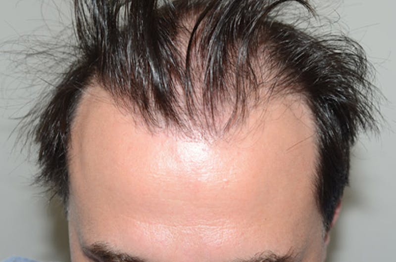 Hair Restoration for Men Before & After Gallery - Patient 216489 - Image 1