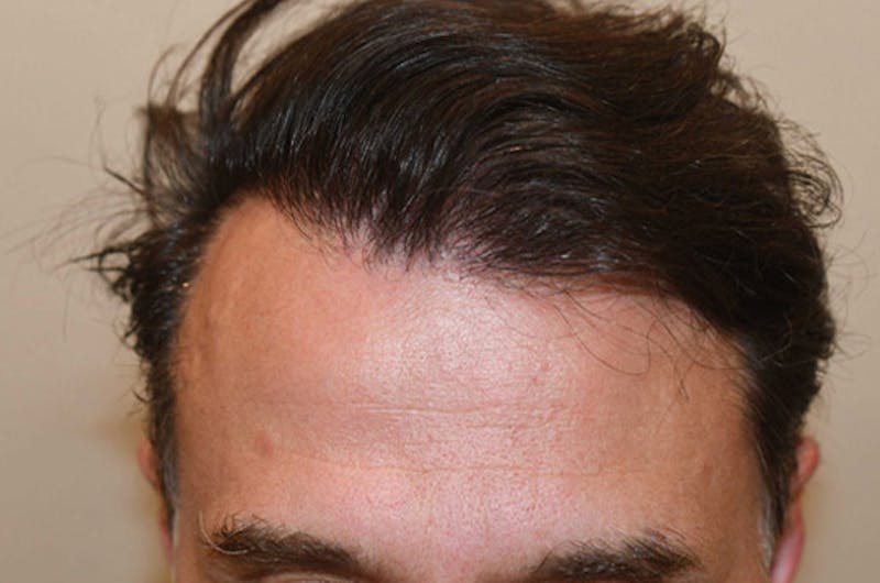 Hair Restoration for Men Before & After Gallery - Patient 216489 - Image 2