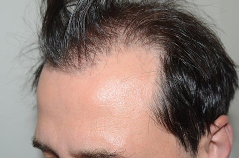 Hair Restoration for Men Before & After Gallery - Patient 216489 - Image 3