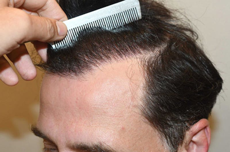 Hair Restoration for Men Before & After Gallery - Patient 216489 - Image 4