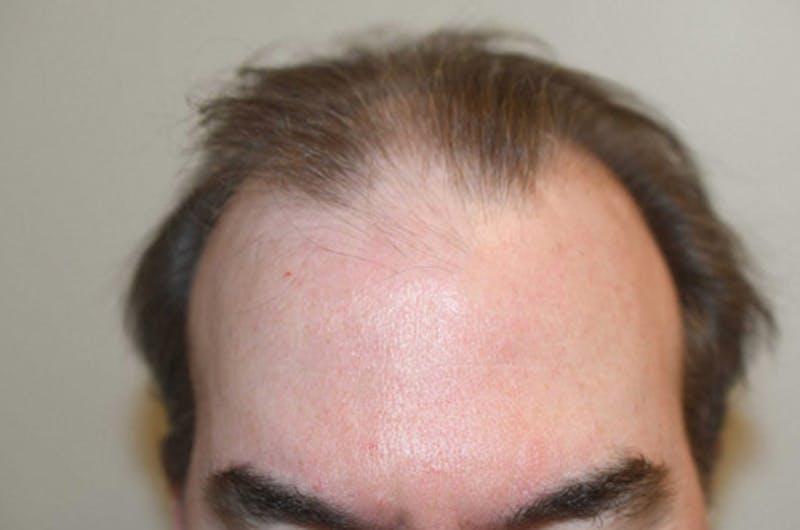 Hair Restoration for Men Before & After Gallery - Patient 254643 - Image 1