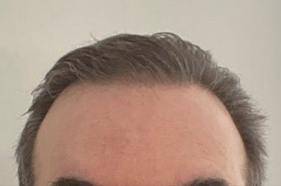 Hair Restoration for Men Before & After Gallery - Patient 418274 - Image 2