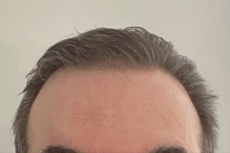 Hair Restoration for Men Before & After Gallery - Patient 254643 - Image 2