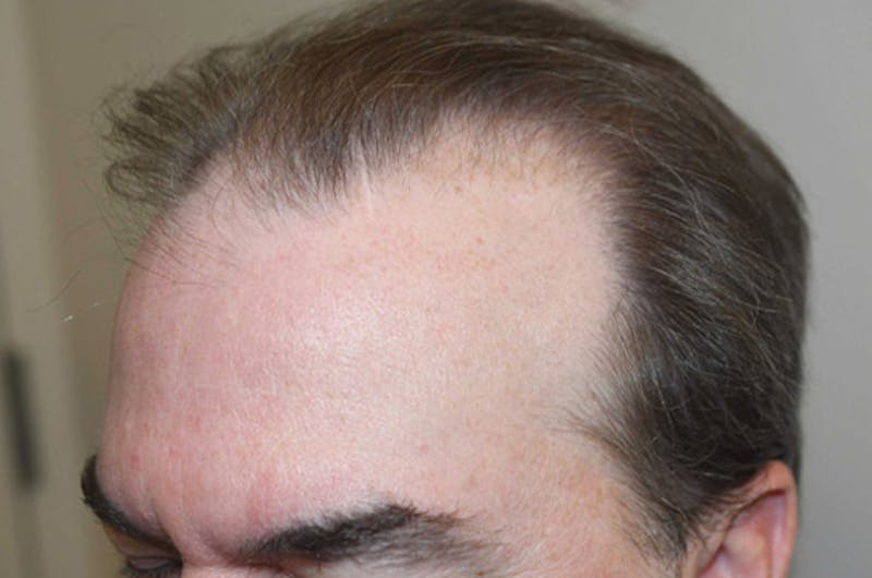 Hair Restoration for Men Before & After Gallery - Patient 254643 - Image 3