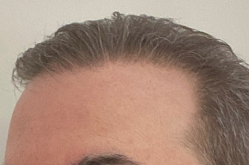 Hair Restoration for Men Before & After Gallery - Patient 254643 - Image 4