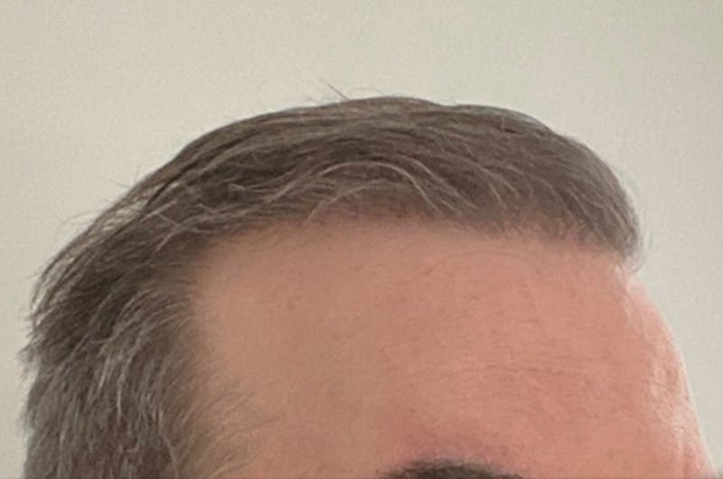 Hair Restoration for Men Before & After Gallery - Patient 254643 - Image 6