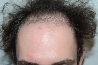 Hair Restoration for Men Before & After Gallery - Patient 165132 - Image 1