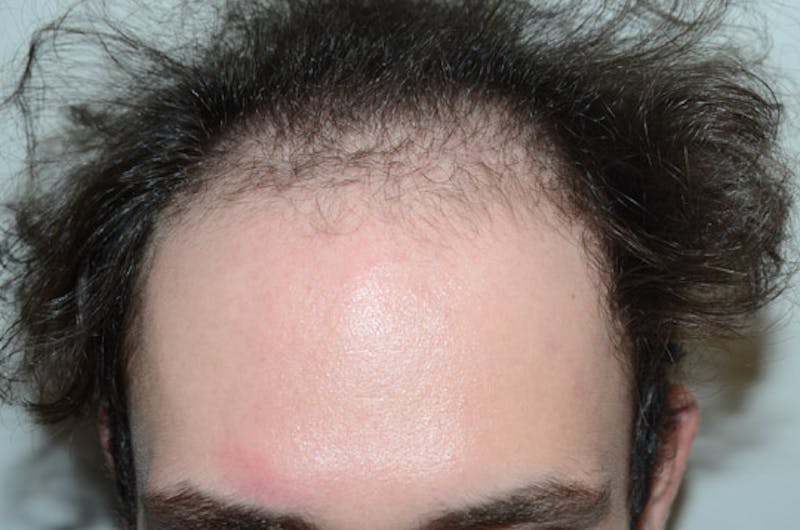 Hair Transplant Repair Before & After Gallery - Patient 224070 - Image 1