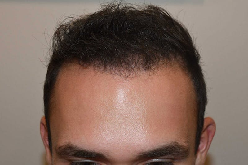 Hair Transplant Repair Before & After Gallery - Patient 224070 - Image 2