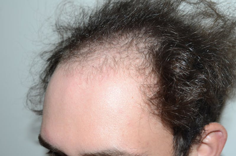 Hair Transplant Repair Before & After Gallery - Patient 224070 - Image 3