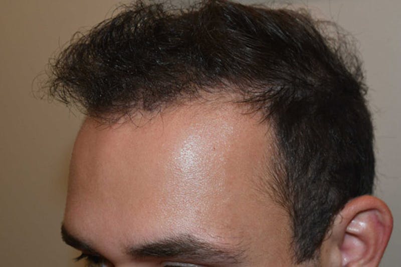 Hair Transplant Repair Before & After Gallery - Patient 224070 - Image 4