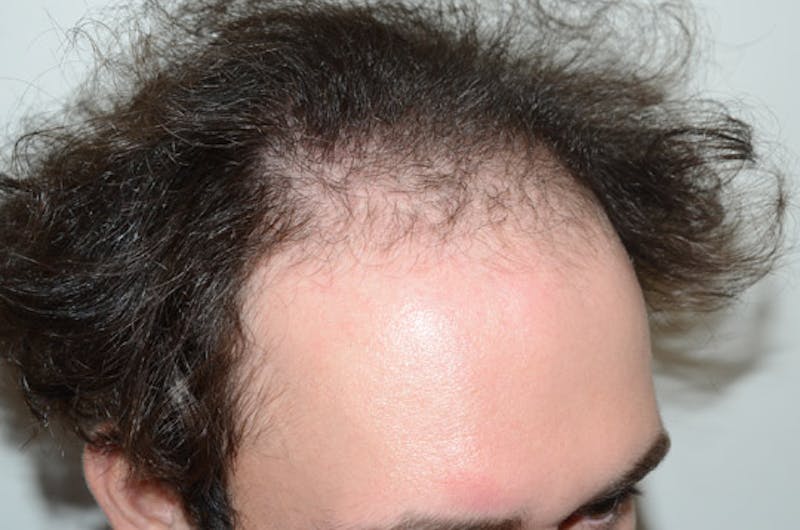 Hair Transplant Repair Before & After Gallery - Patient 224070 - Image 5
