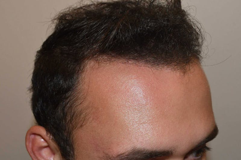 Hair Transplant Repair Before & After Gallery - Patient 224070 - Image 6
