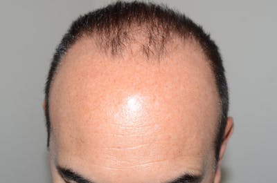 Hair Restoration for Men Before & After Gallery - Patient 295414 - Image 1