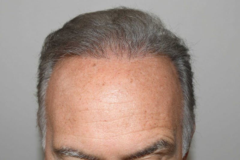 Hair Restoration for Men Before & After Gallery - Patient 378568 - Image 2