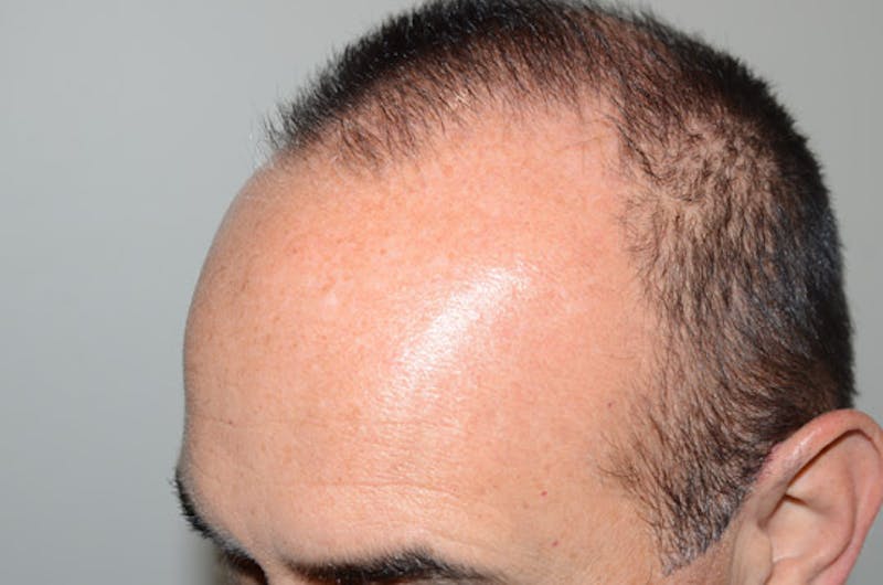 Hair Restoration for Men Before & After Gallery - Patient 378568 - Image 3