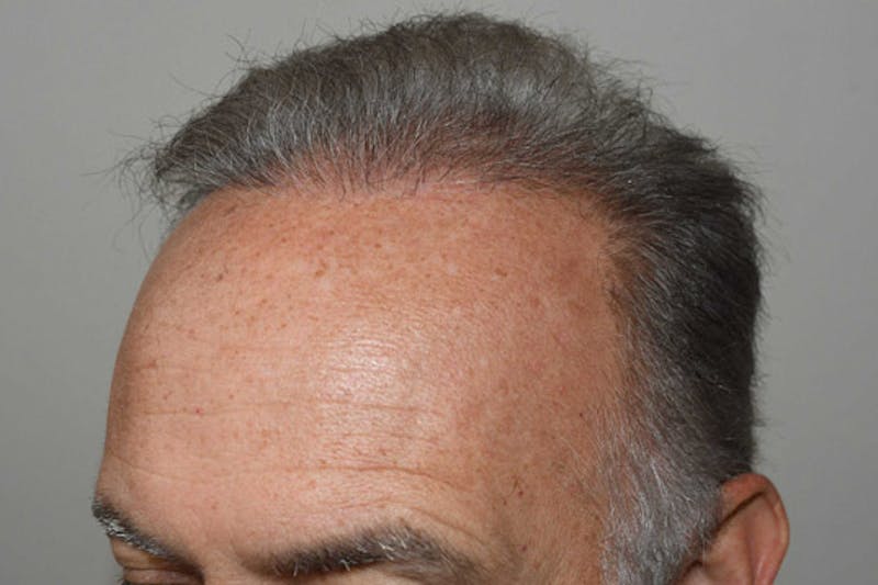 Hair Restoration for Men Before & After Gallery - Patient 378568 - Image 4