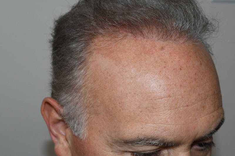 Hair Restoration for Men Before & After Gallery - Patient 378568 - Image 6