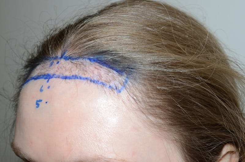 Hairline Lowering Surgery Before & After Gallery - Patient 306857 - Image 3