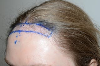 Hair Transplant Repair Before & After Gallery - Patient 294812 - Image 4