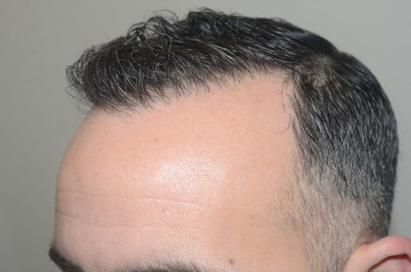 Hair Restoration for Men Before & After Gallery - Patient 162049 - Image 3