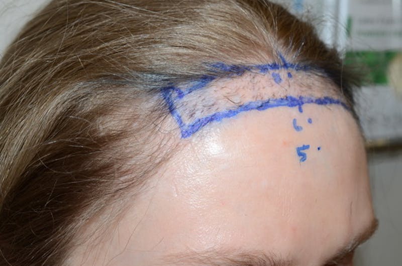 Hairline Lowering Surgery Before & After Gallery - Patient 306857 - Image 5