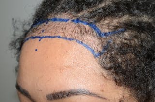 Hairline Lowering Surgery Before & After Gallery - Patient 640583 - Image 4