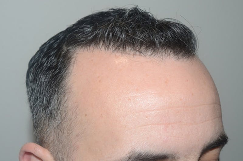 Hair Restoration for Men Before & After Gallery - Patient 162049 - Image 5
