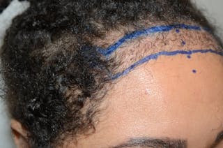 Hairline Lowering Surgery Before & After Gallery - Patient 640583 - Image 6